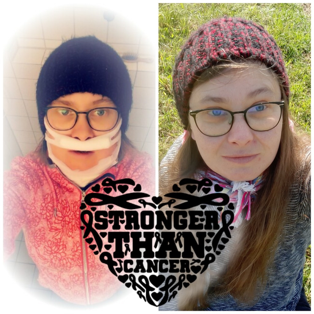 Collage- 2x die gleiche Frau
Bild links: Frau mit Mütze kurz nach einer OP an der Nase
Bild rechts: Frau mit Mütze und langen Haaren die in die Kamera lacht